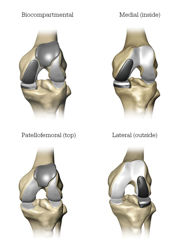 Mako-Partial-Knee-Replacement-Implant-Locations
